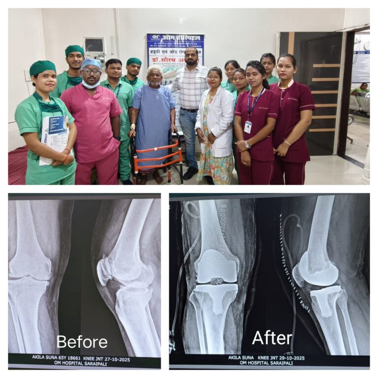 ओम हॉस्पिटल, सरायपाली में आधुनिक चिकित्सा से घुटने का प्रत्यारोपण सफलतापूर्वक किया गया 